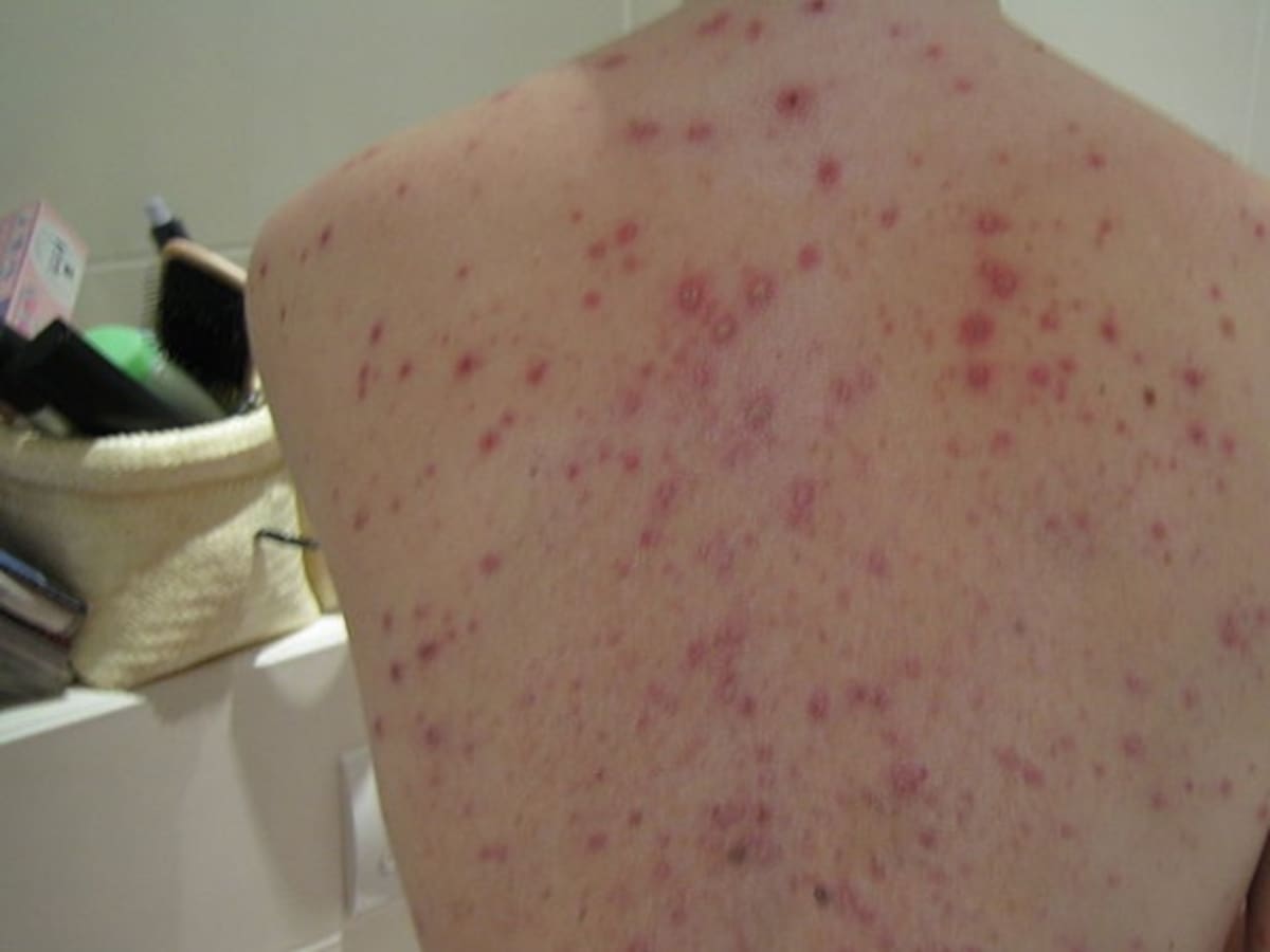 Siete casos de varicela reportados en la cárcel de San José de Guaviare