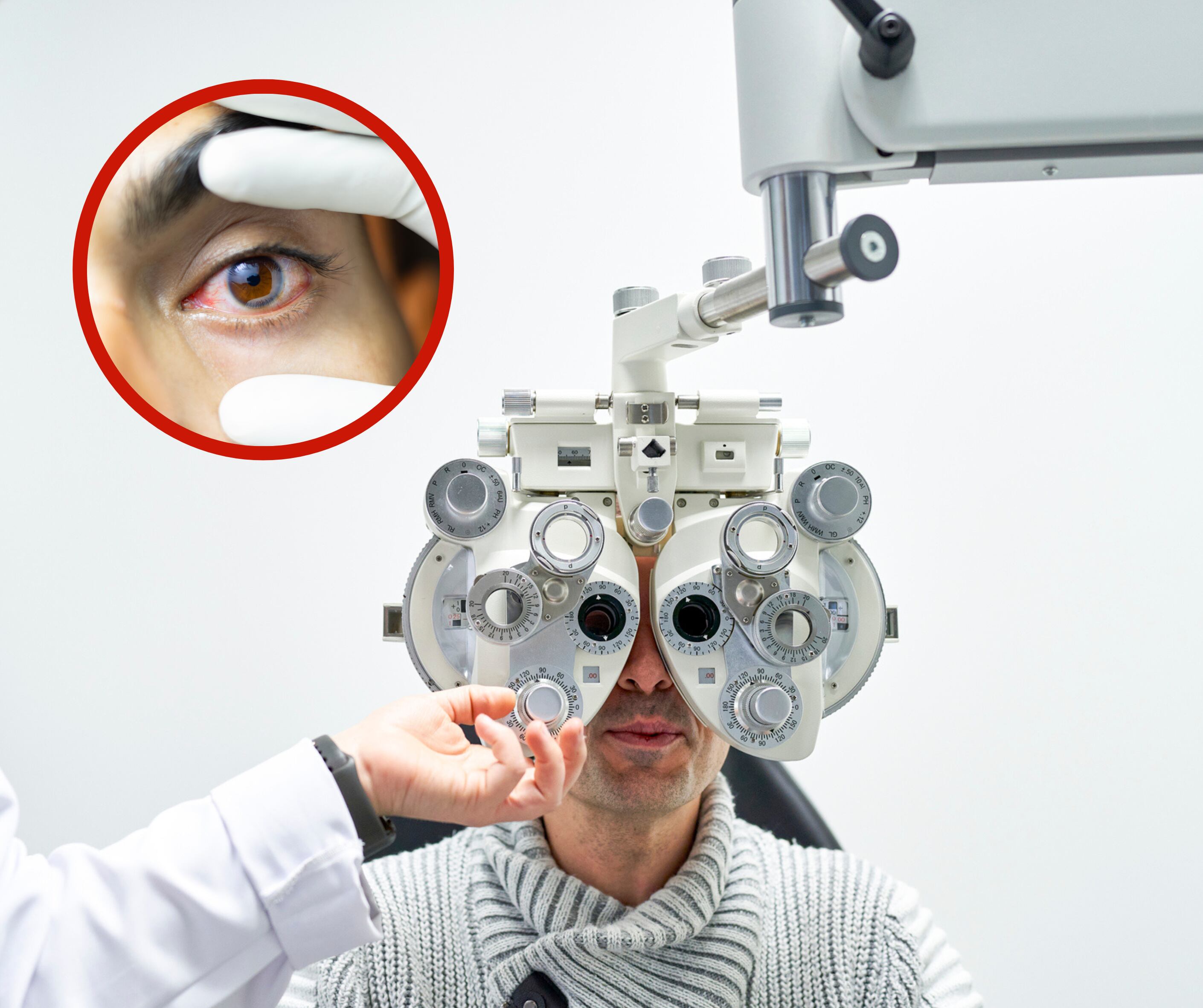 Paciente de oftalmología siendo examinado en un consultorio junto a la imagen de un ojo irritado (Getty Images)