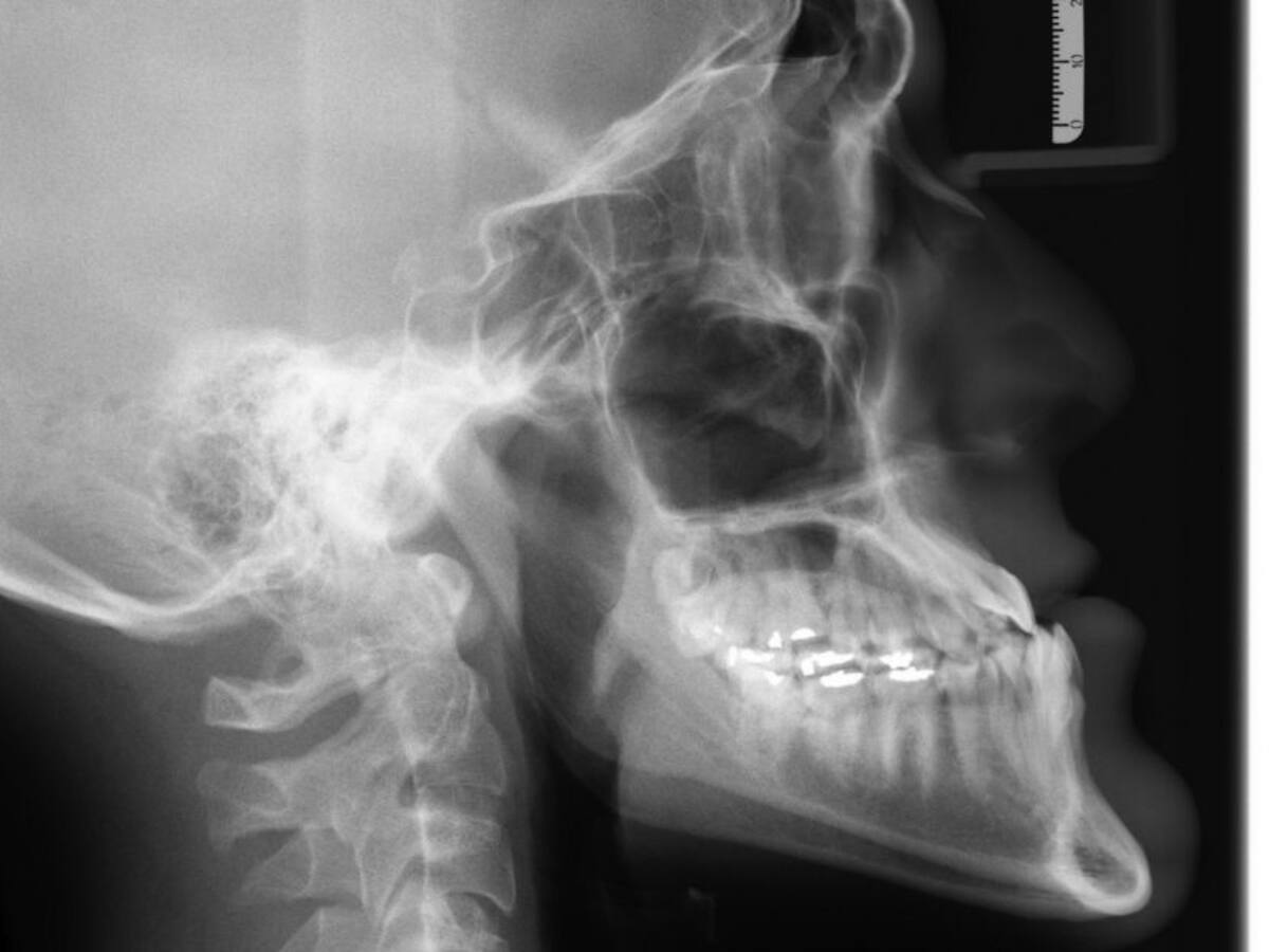 ¿Cómo evitar enfermedades relacionadas con los huesos?