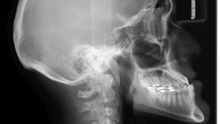 ¿Cómo evitar enfermedades relacionadas con los huesos?