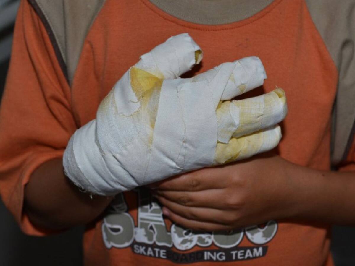 A 12 sube la cifra de quemados con pólvora en Caldas