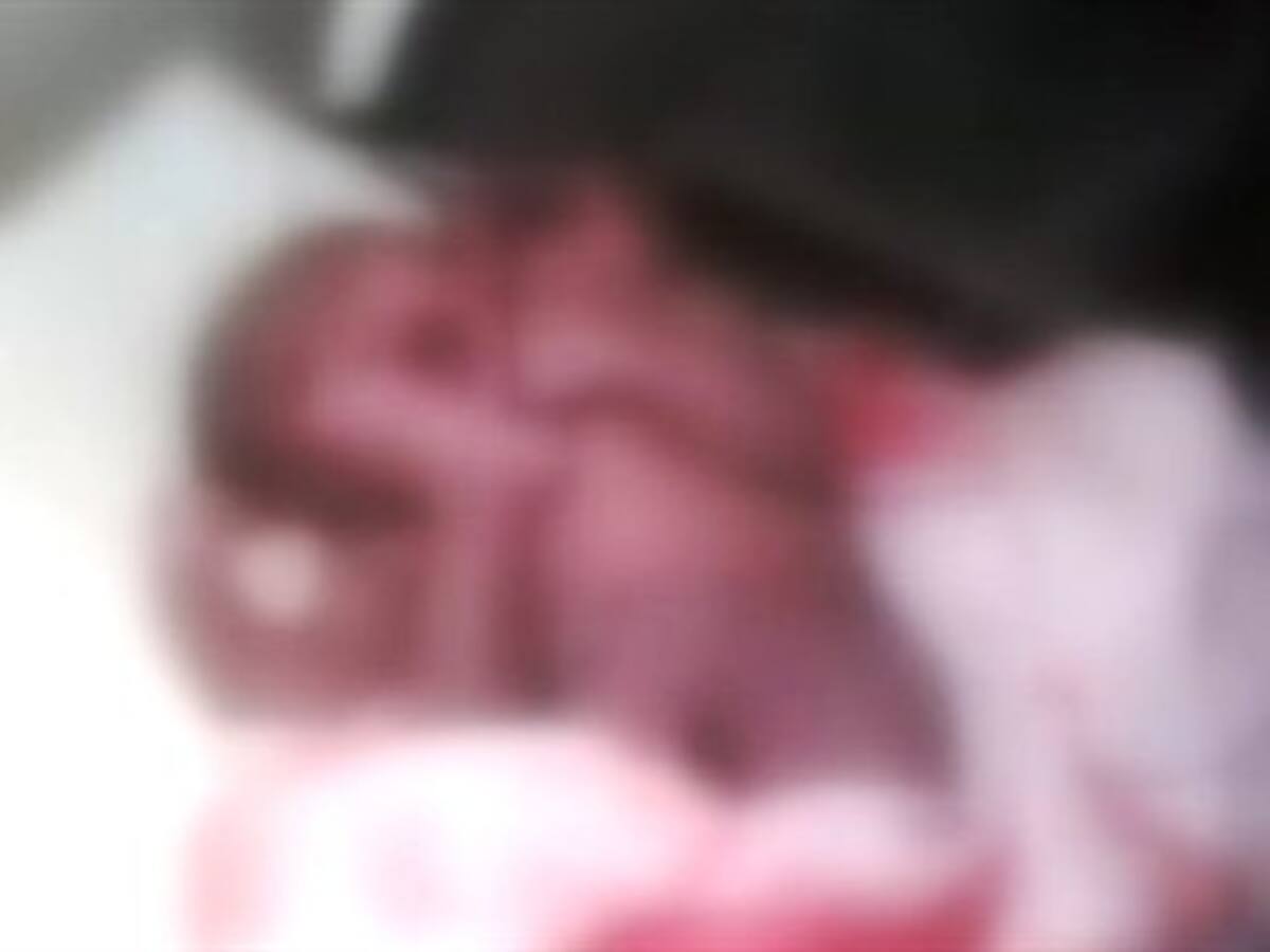 Consternación en Sincelejo por el nacimiento de una bebé bicéfala