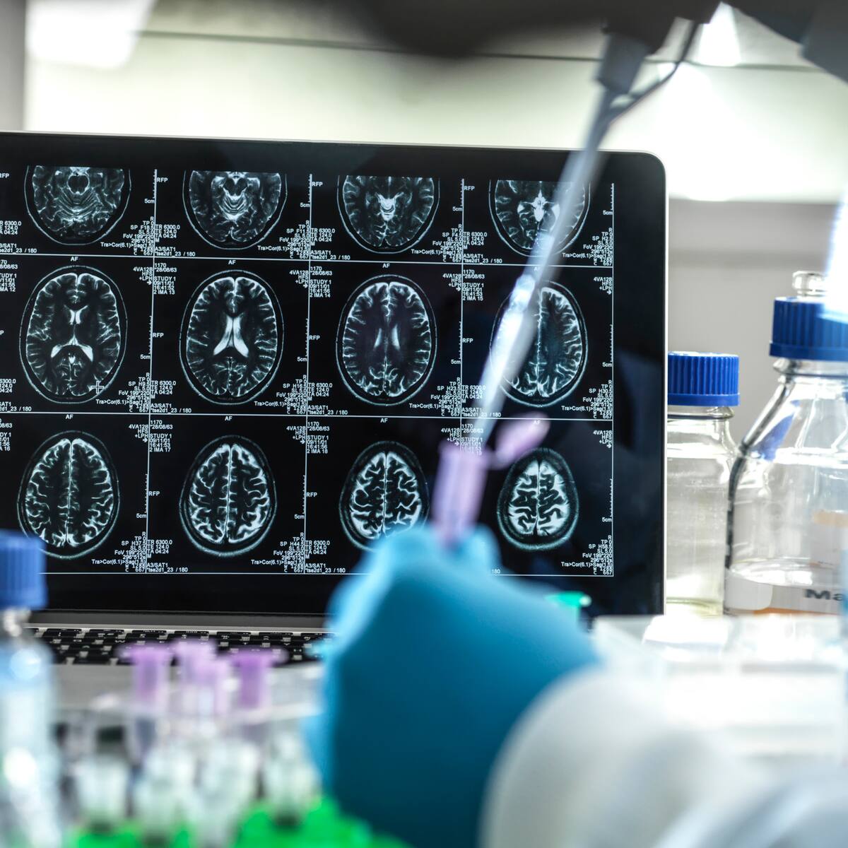 Un colombiano fue el segundo caso de resistencia al Alzheimer: ¿qué significa?