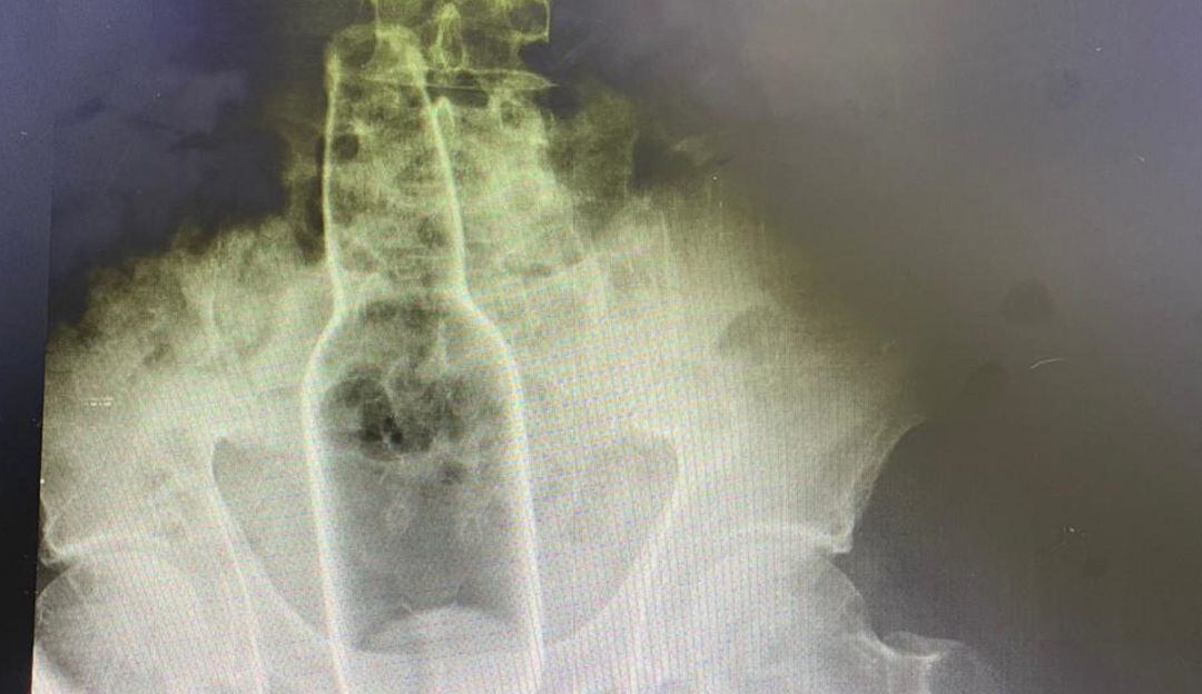 Radiografía del cuerpo extraño introducido en el recto del extranjero.