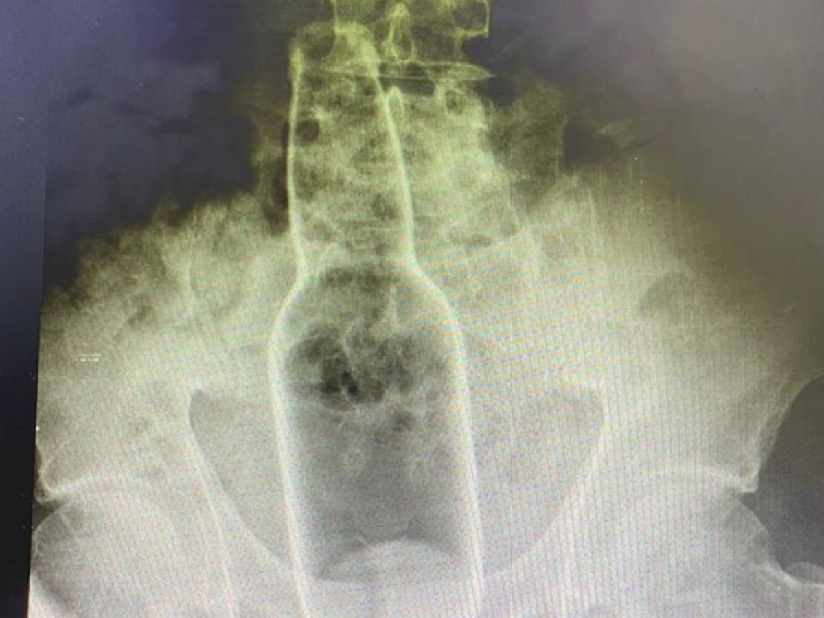 En Santa Marta hombre se habría introducido una botella en su recto