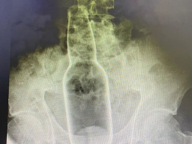 Radiografía del cuerpo extraño introducido en el recto del extranjero. 