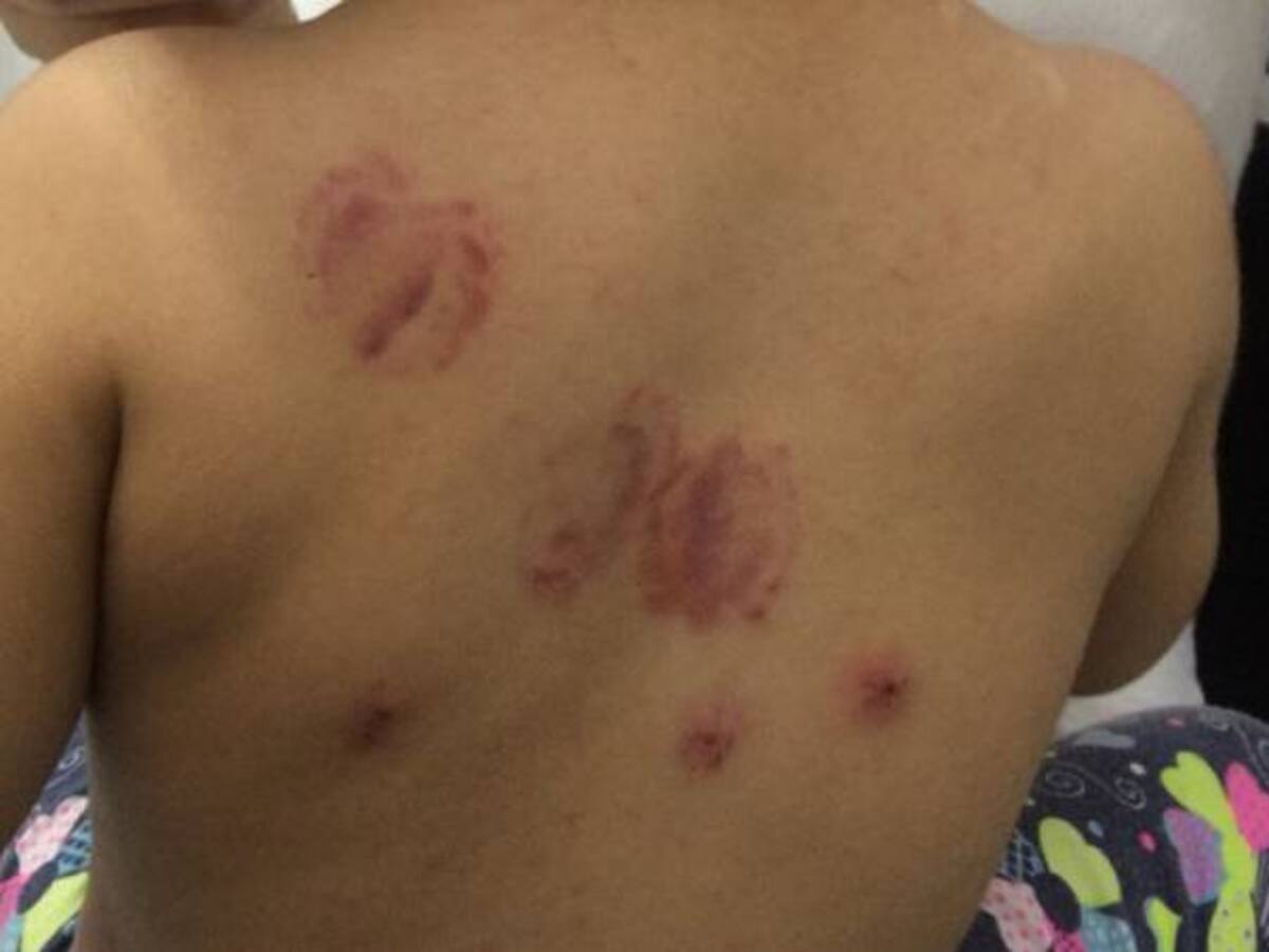 Atacada a mordiscos niña de dos años en en Palmira