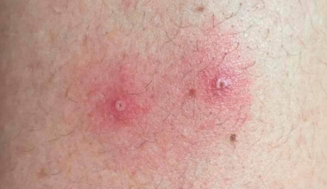 Tras confirmarse dos casos nuevos de viruela símica el departamento del Huila llegó a 5 en total, cuatro son hombres y una mujer.