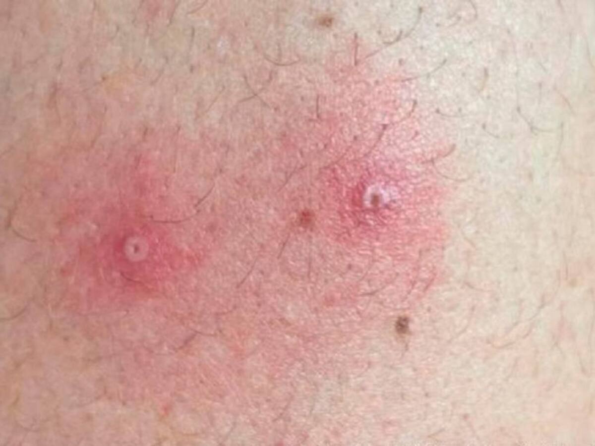 Dos casos más de viruela símica se reportan en el Huila