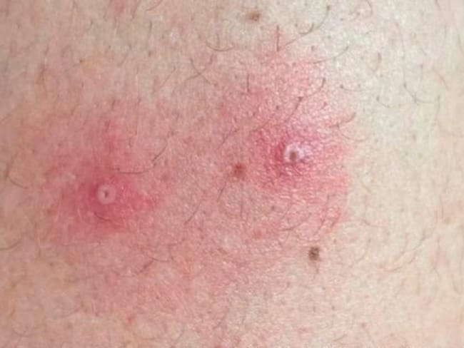 Tras confirmarse dos casos nuevos de viruela símica el departamento del Huila llegó a 5 en total, cuatro son hombres y una mujer.