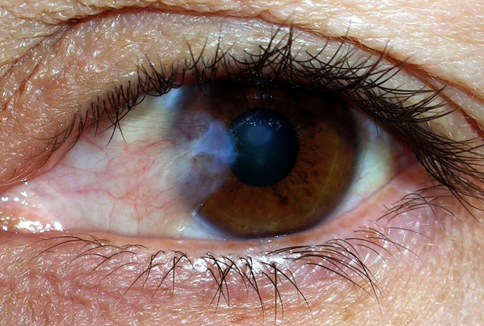 Los municipios con el mayor número de casos notificados son Neiva 7 casos, San Agustín 5 casos y Pitalito 3 casos.