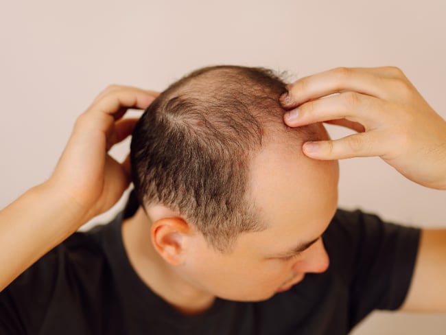 Populares bebidas estarían asociadas a la pérdida de cabello de los hombres // Caracol Radio