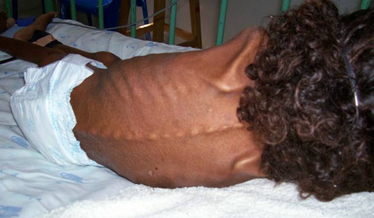 Menor con cuadro severo de desnutrición.