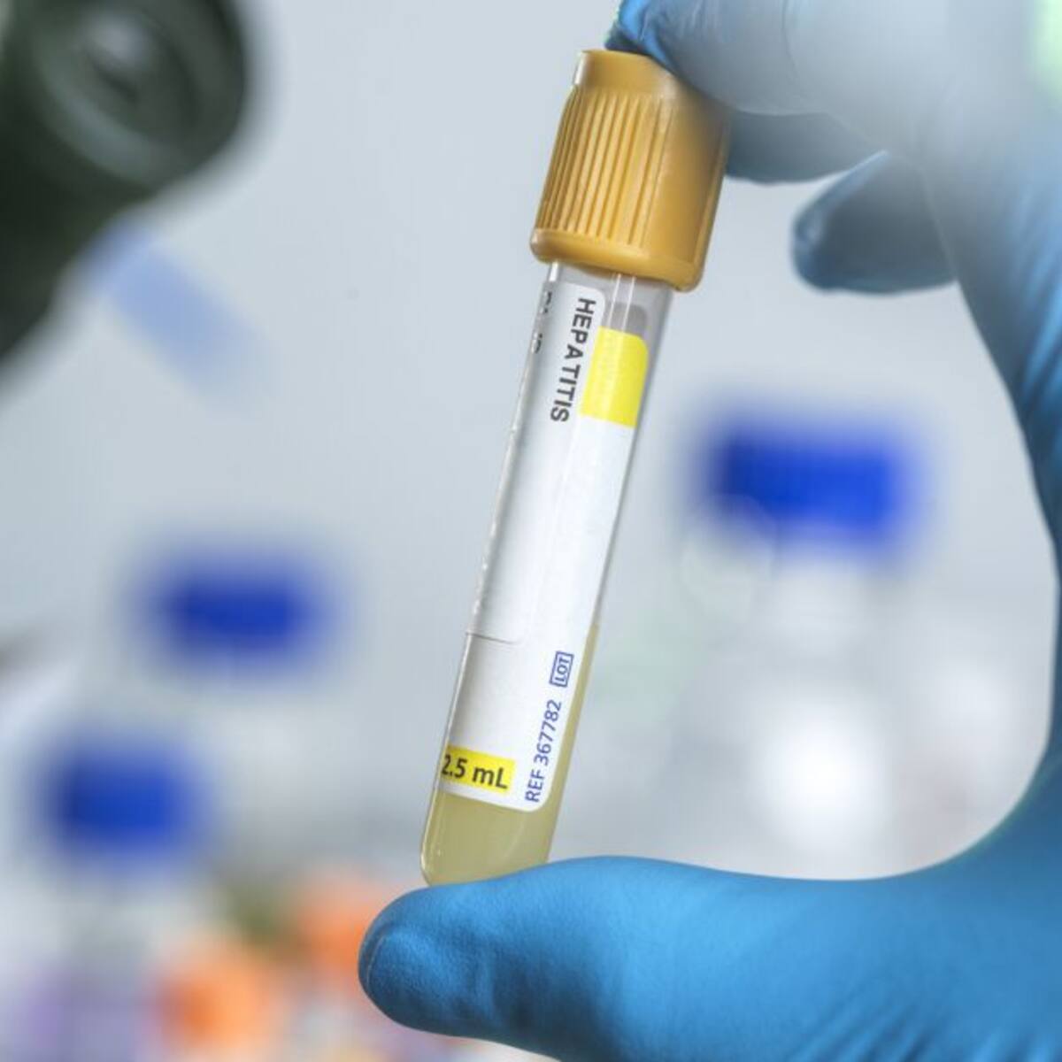 Latinoamérica no registra casos de hepatitis aguda infantil