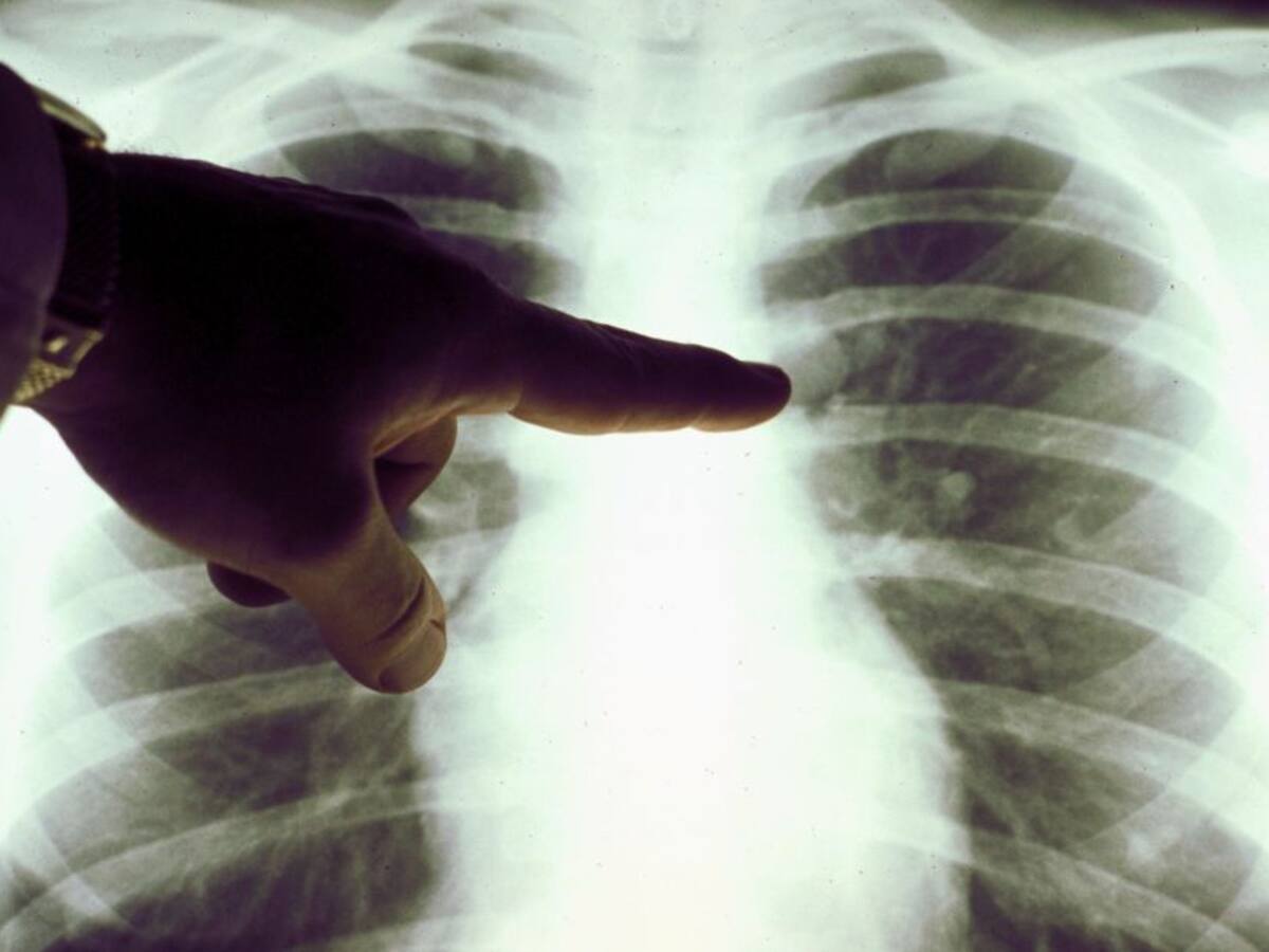 Disminuyó drásticamente exámenes para detectar cáncer en Colombia