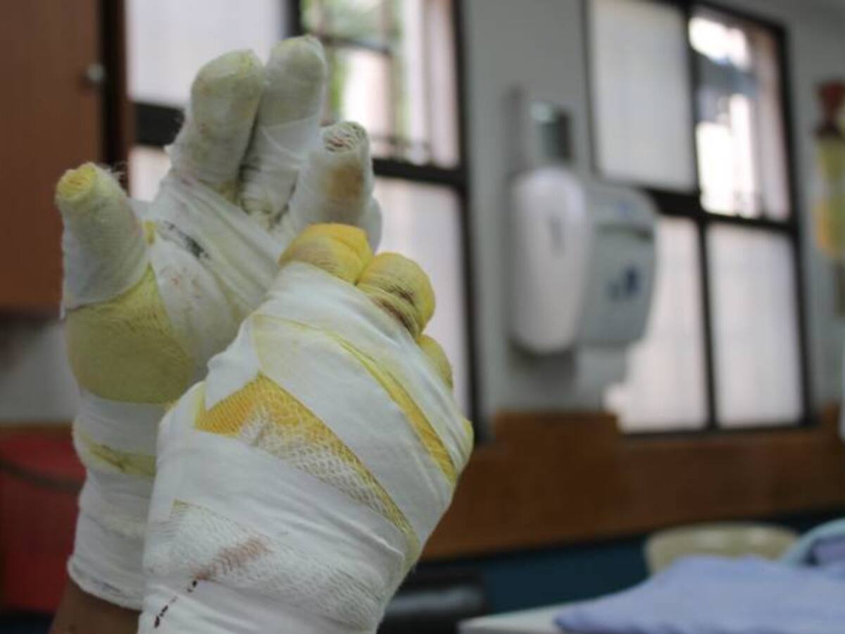 Reportan el primer caso de un adulto quemado con pólvora en Boyacá