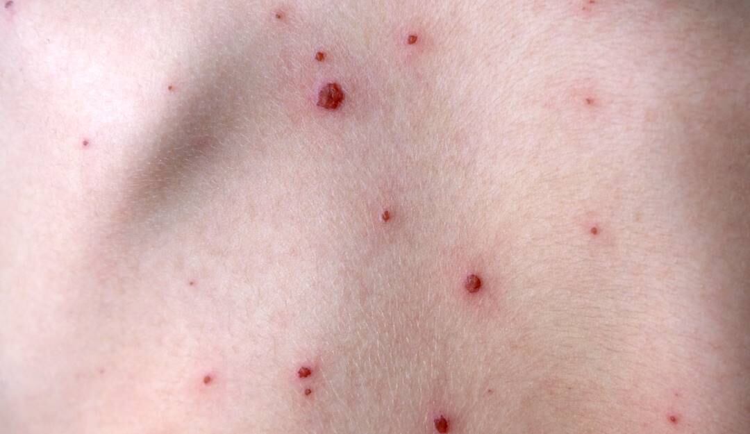 Se presentaron 29 casos nuevos de Viruela del Mono en Colombia. Foto: Getty Images. 