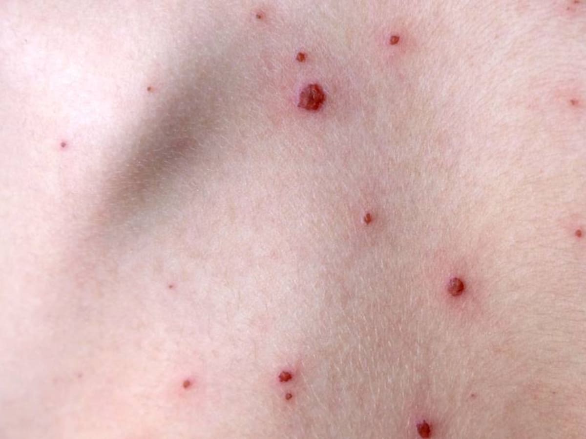 MinSalud confirmó que ya hay 84 contagiados con Viruela del Mono en Colombia