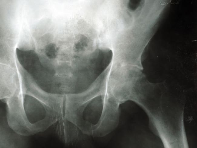 Conozca cómo prevenir la osteoporosis a tiempo