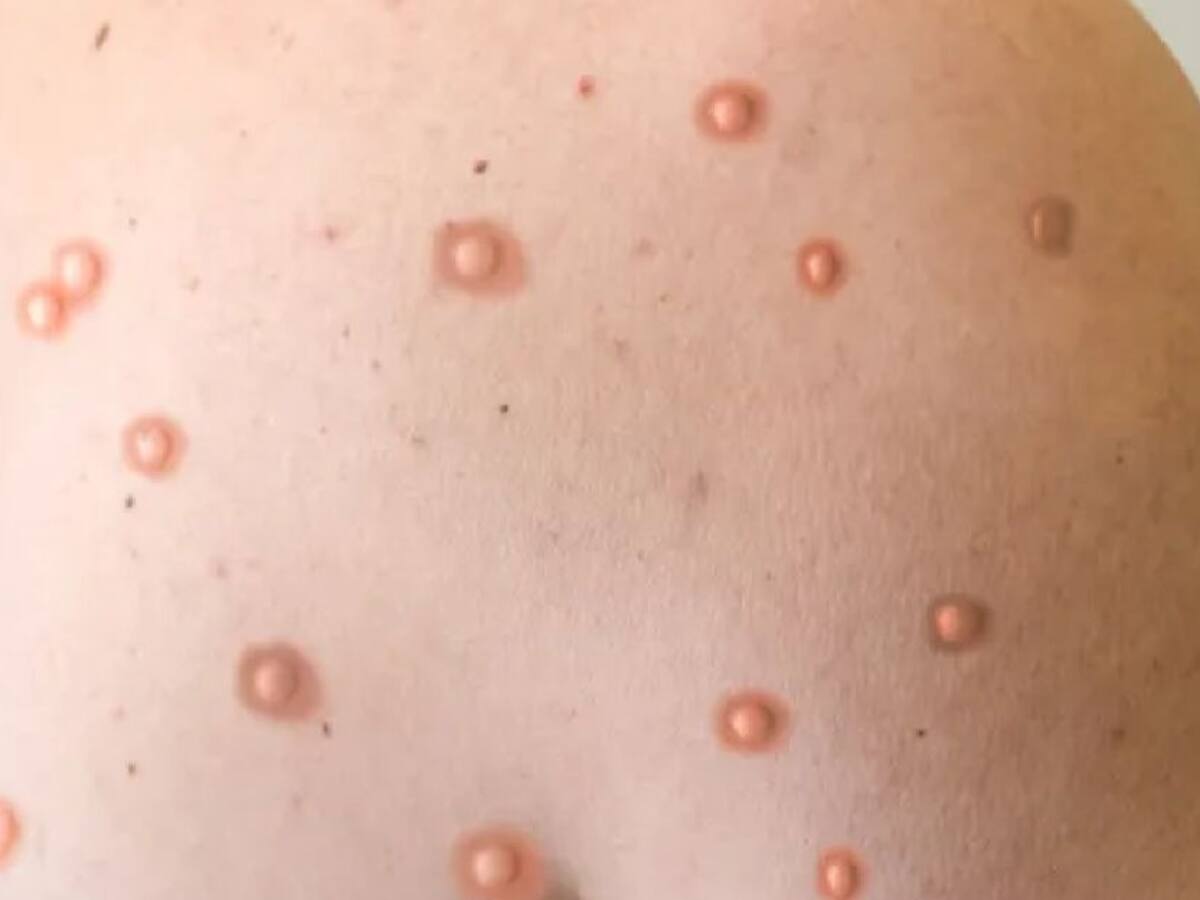 Intensifican vigilancia de viruela símica en Bucaramanga