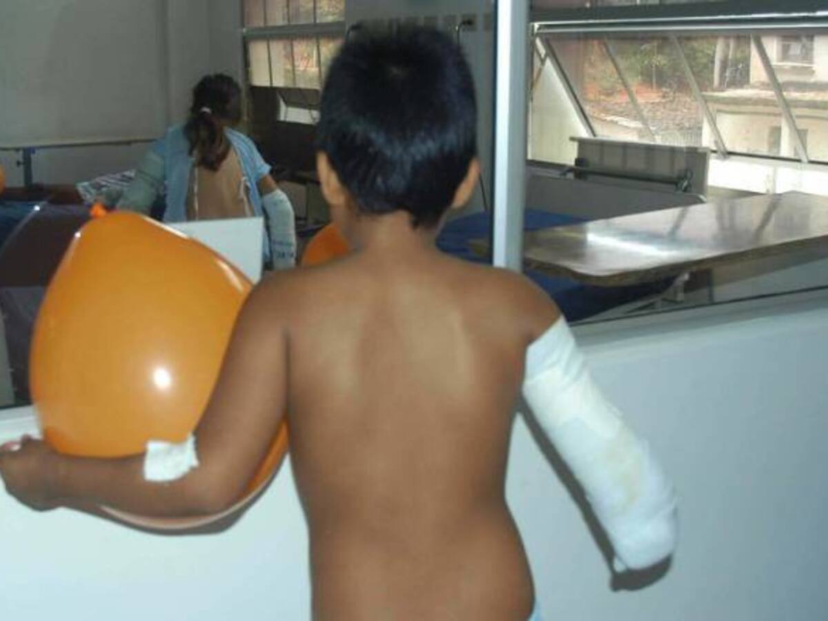 En Colombia 37 pacientes han sido amputados por quemaduras con pólvora