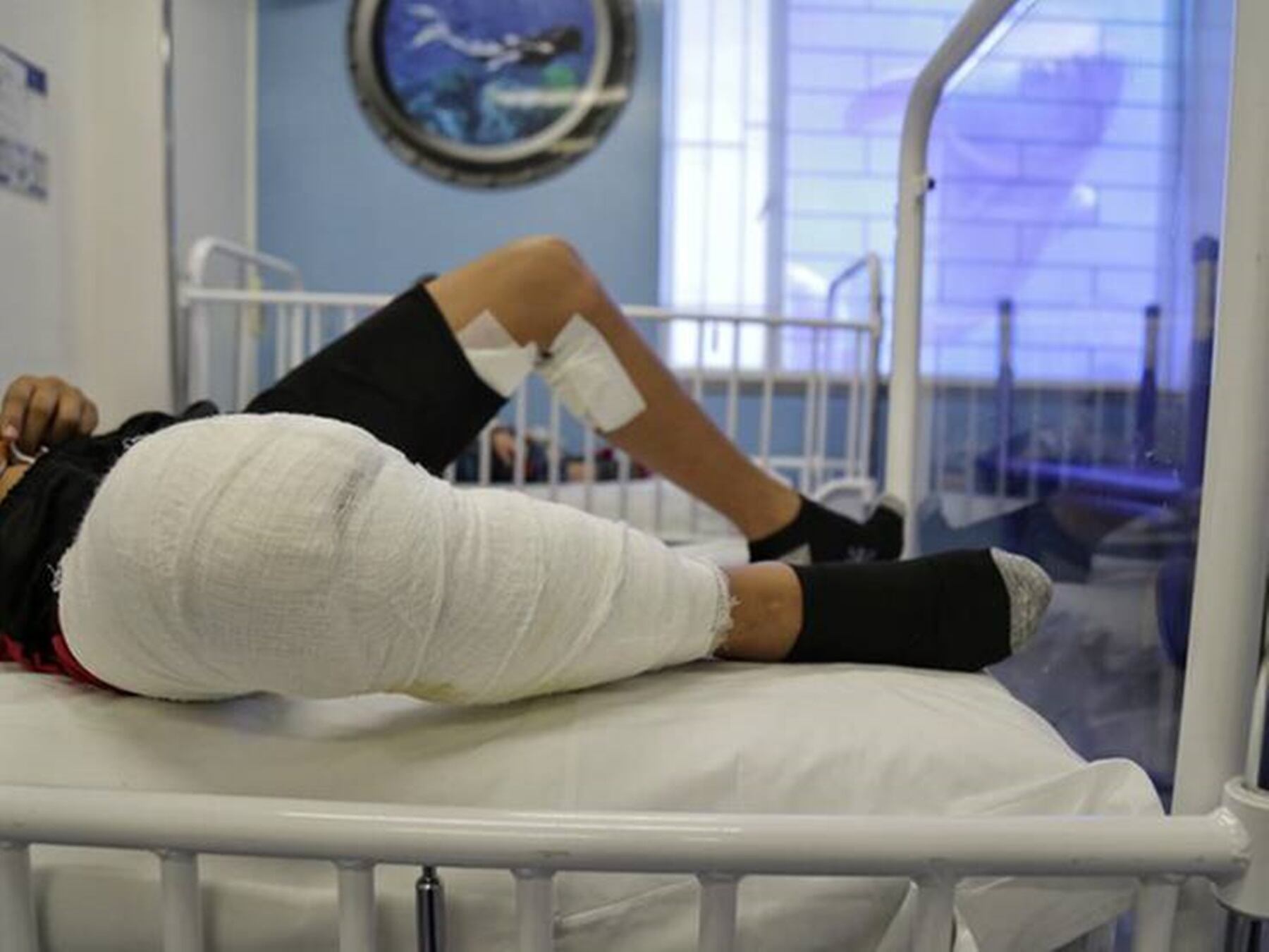 Quemado con pólvora - Referencia