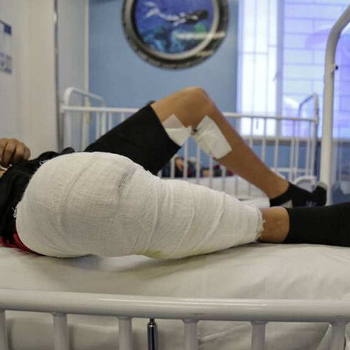 Reportan la primera persona quemada con pólvora en el Atlántico