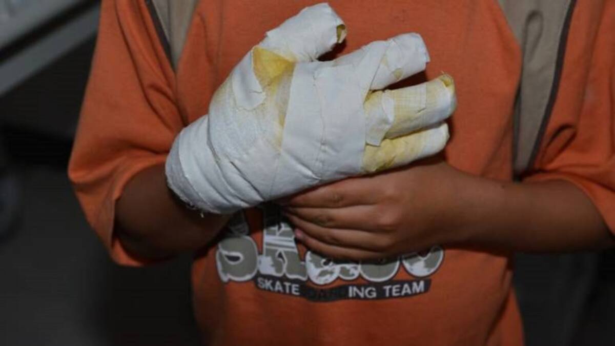 Icbf ya amonestó a dos padres de familia porque sus hijos resultaron quemados pólvora