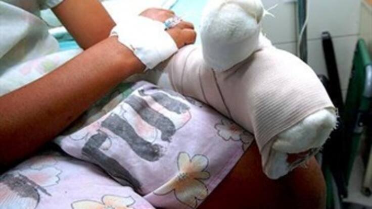 11 nuevos casos de niños quemados por pólvora, ya van 253 en total en diciembre