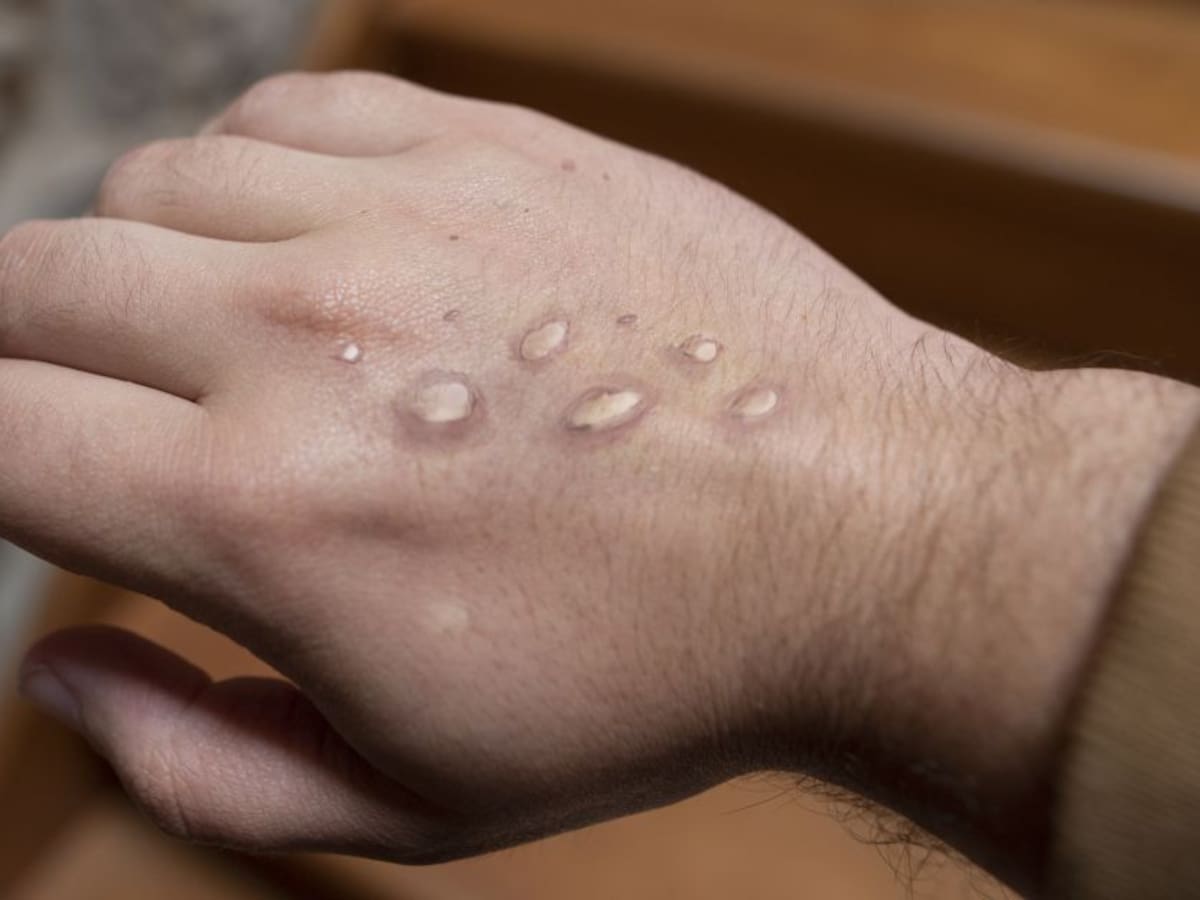 Viruela del mono: ¿cómo evitar la propagación en Colombia?