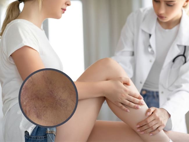 Imagen de referencia // mujer siendo atendida por un experto de la salud // En el círculo varices en una pierna // Getty Images //