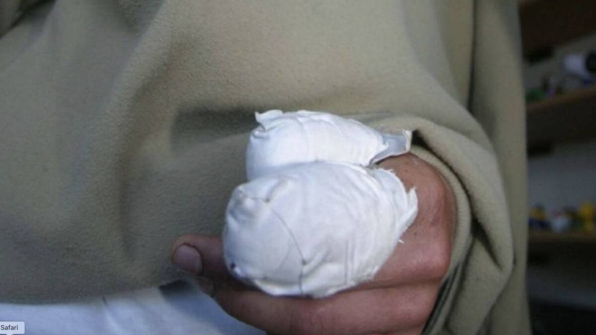 Un menor de 13 años se quemó tras manipular una papeleta alicorado