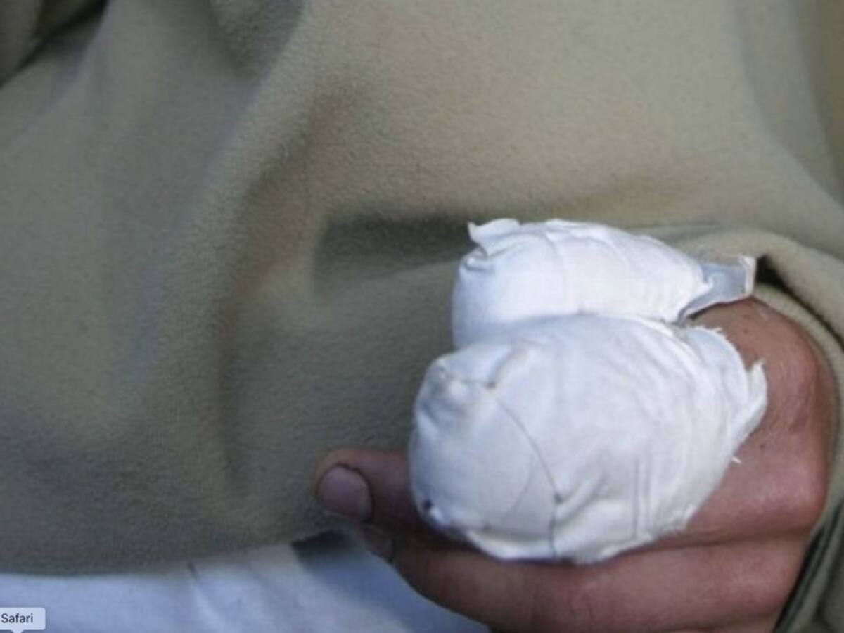 Un menor de 13 años se quemó tras manipular una papeleta alicorado