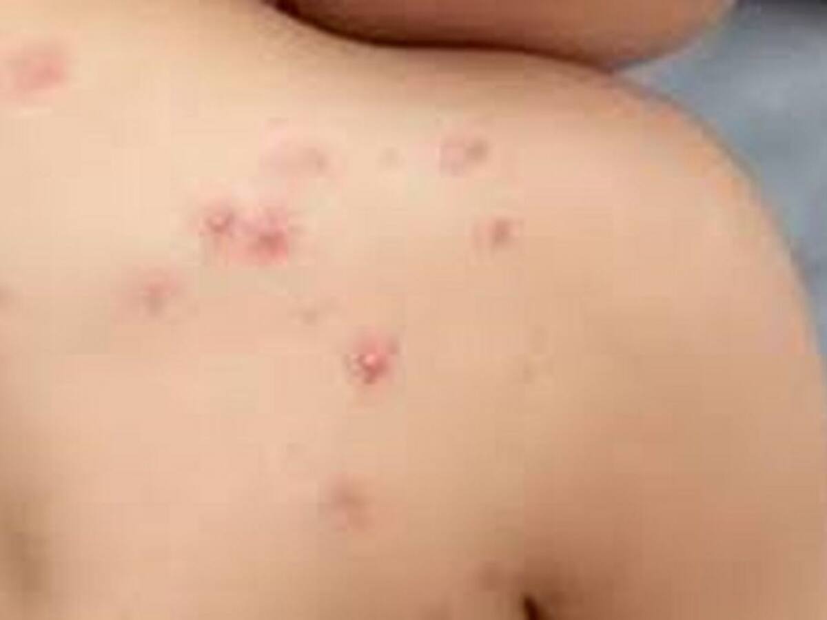 En el Tolima no hay más casos sospechosos de la viruela del mono