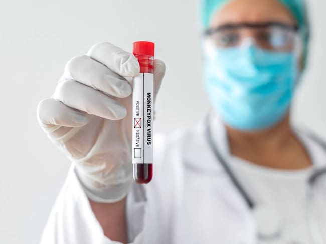 Viruela del Mono by GettyImages