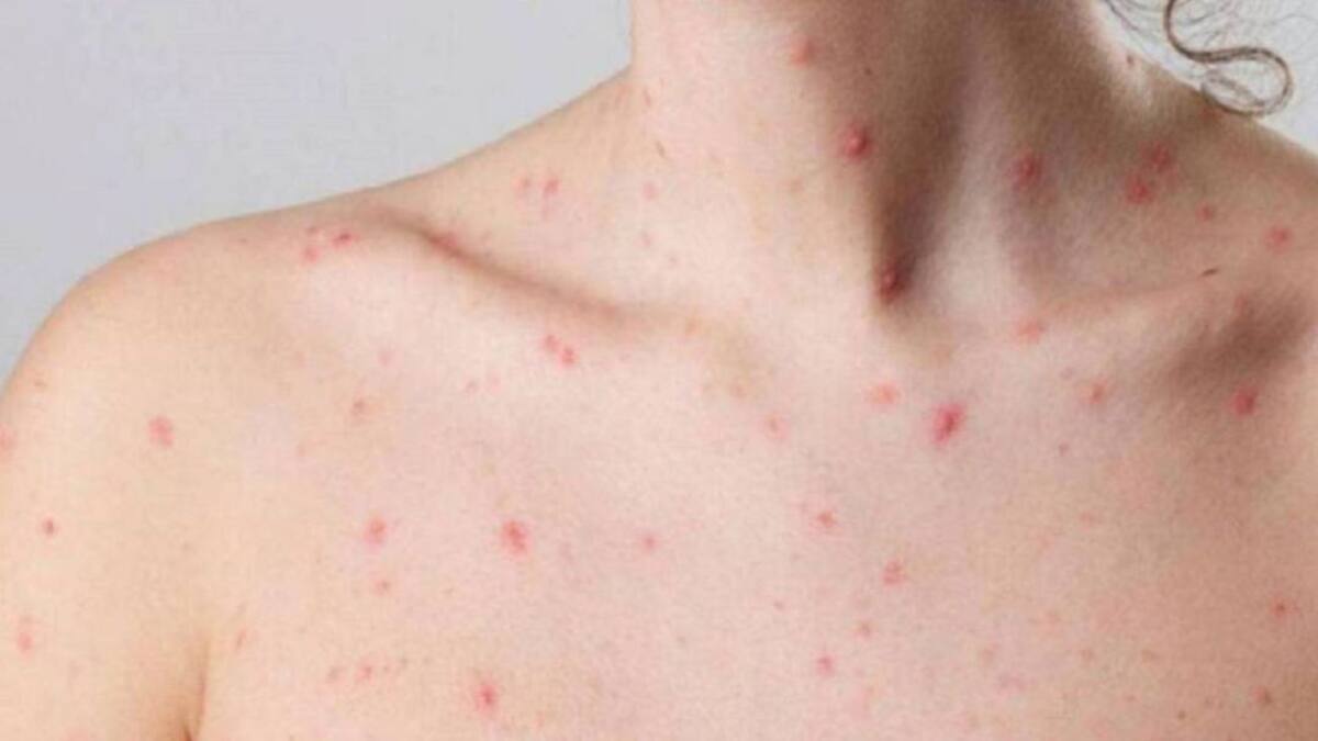 ¿Por qué están creciendo los contagios de viruela del mono en Cali?