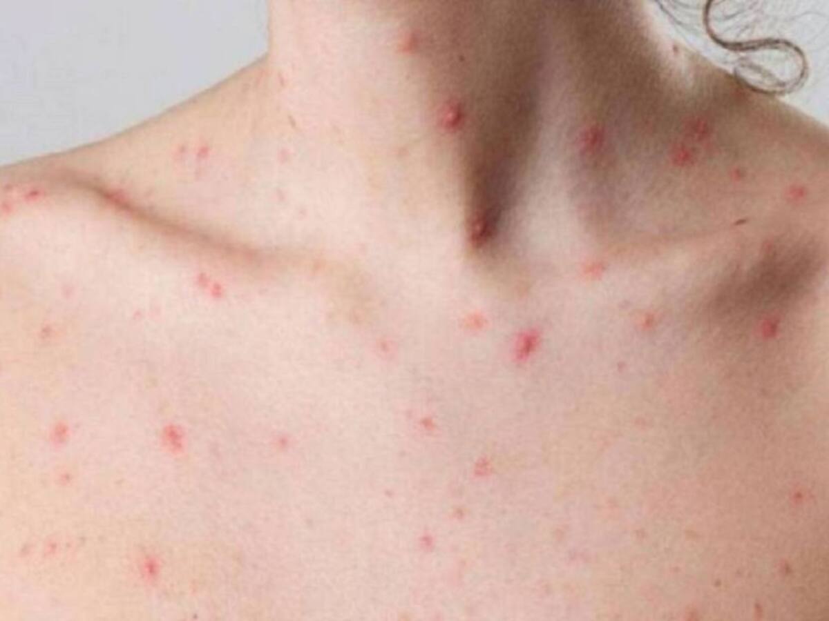 ¿Por qué están creciendo los contagios de viruela del mono en Cali?