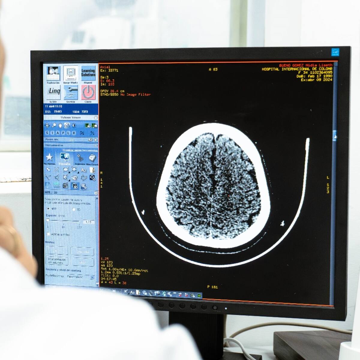 Aumentan los casos de adultos jóvenes diagnosticados con accidentes cerebrovasculares