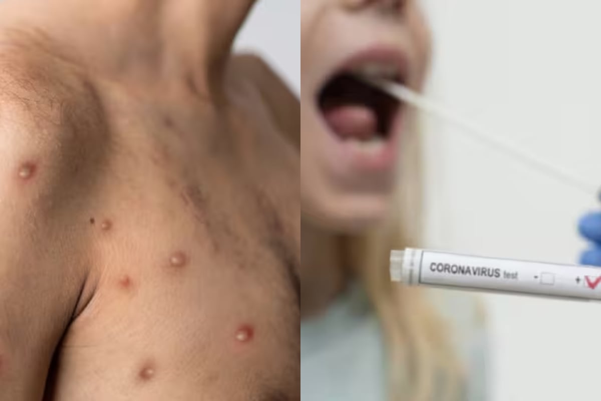 Viruela del mono - COVID 19 - Getty Images