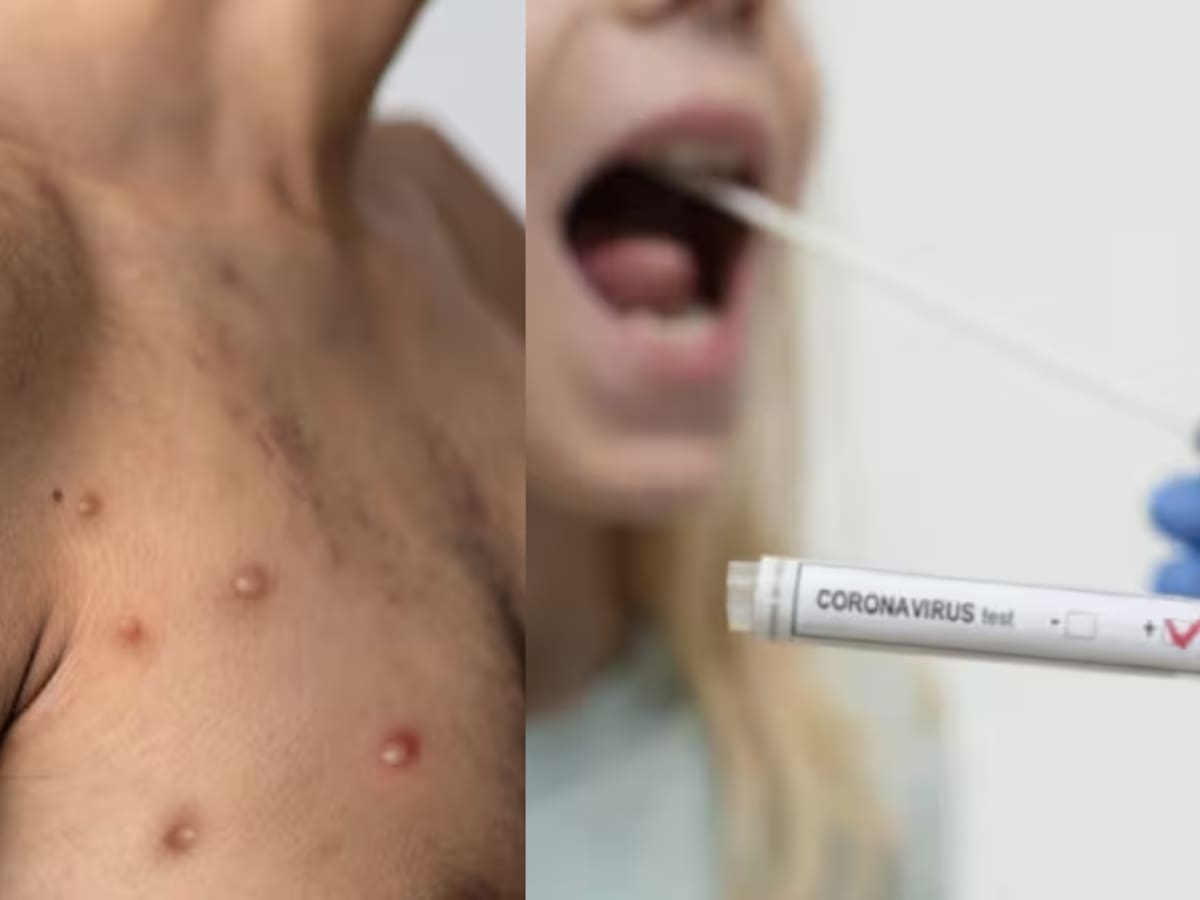 ¿La viruela del mono es más contagiosa que el COVID? Virólogo responde