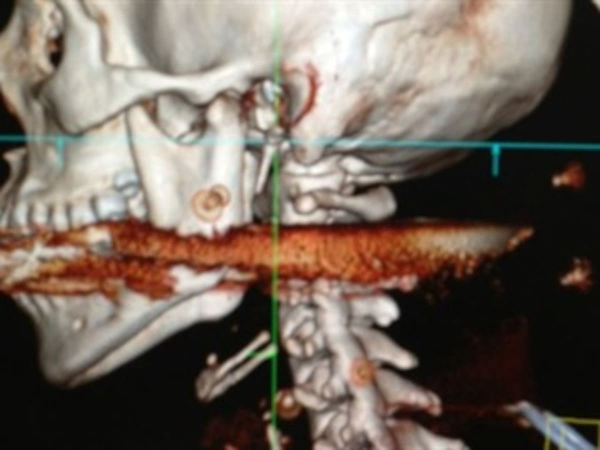 Una mujer recibe un “arponazo” en la garganta y sobrevive