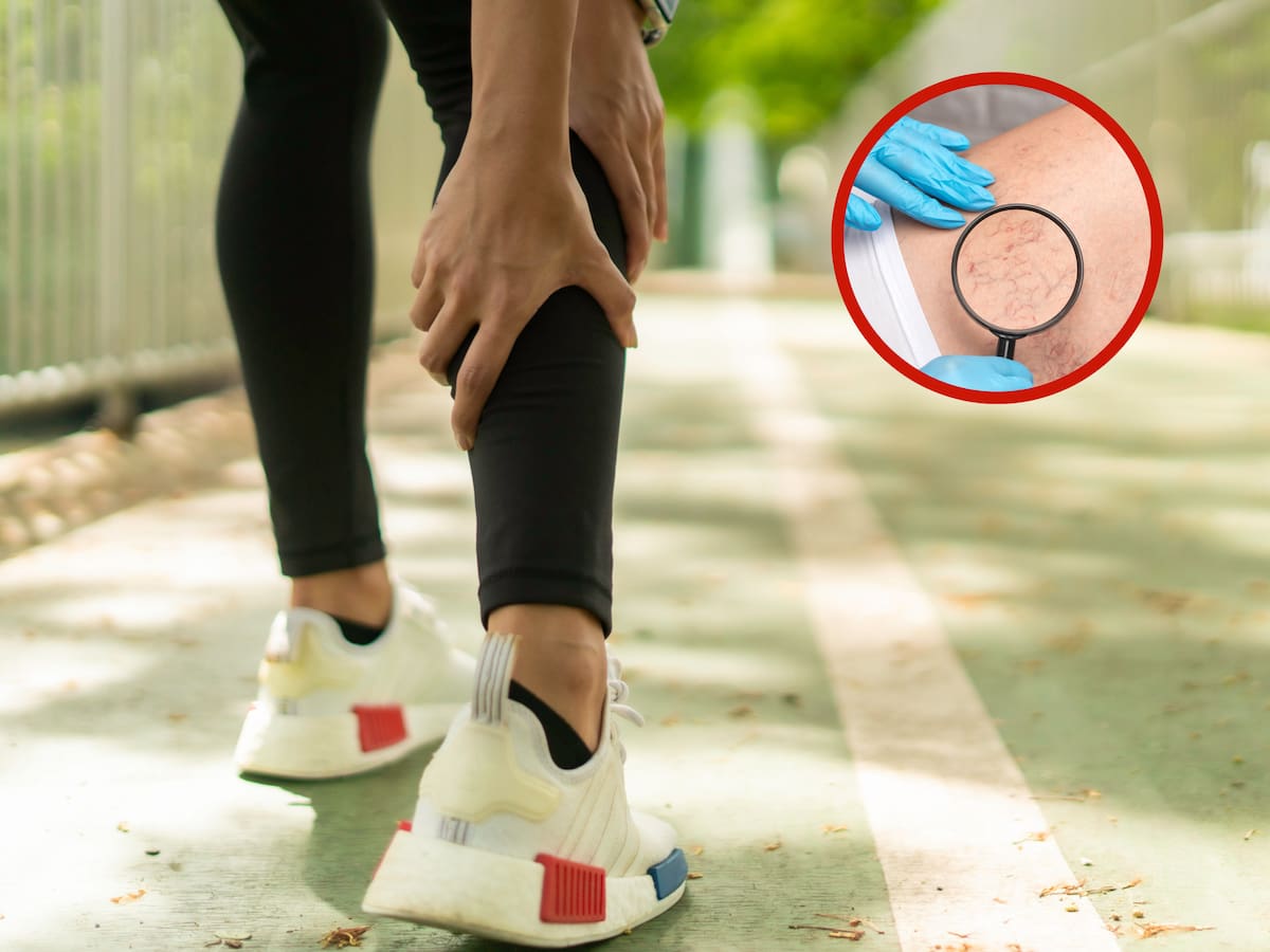¿Es posible eliminar las várices rápidamente? 6 trucos y recomendaciones de expertos