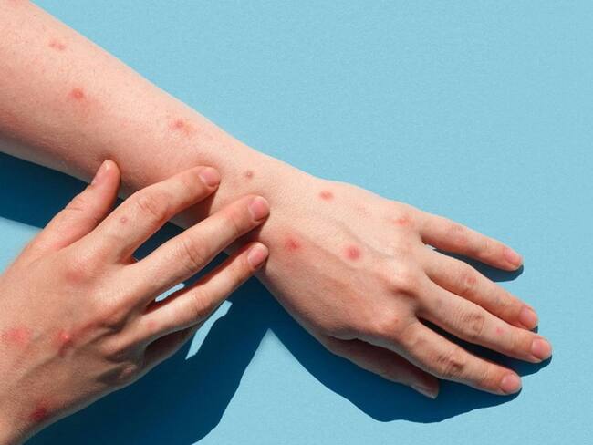 Cuatro casos en estudio en Norte de Santander por Viruela Del Mono