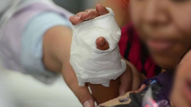 Menores de edad los más afectados por uso de pólvora en el Huila.