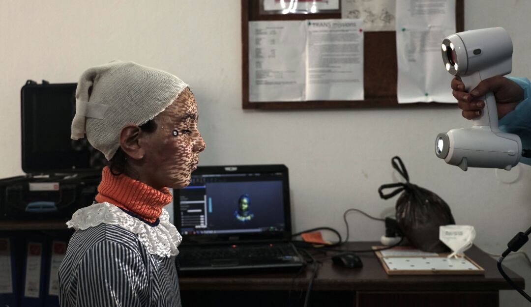 Máscaras impresas en 3D para curar rostros quemados en Gaza