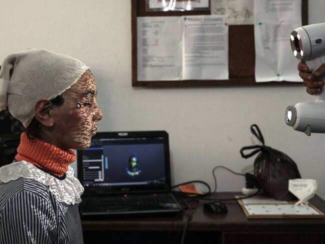 Máscaras impresas en 3D para curar rostros quemados en Gaza
