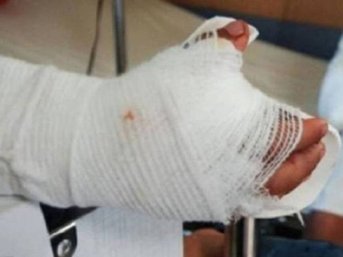 En coma mujer que fue quemada por su pareja en Barranquilla