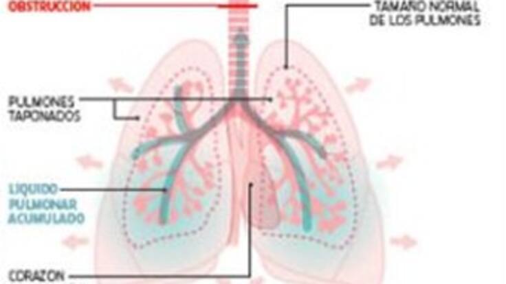 Asombrosa operación a un feto que tenía obstrucción de laringe realizan en España