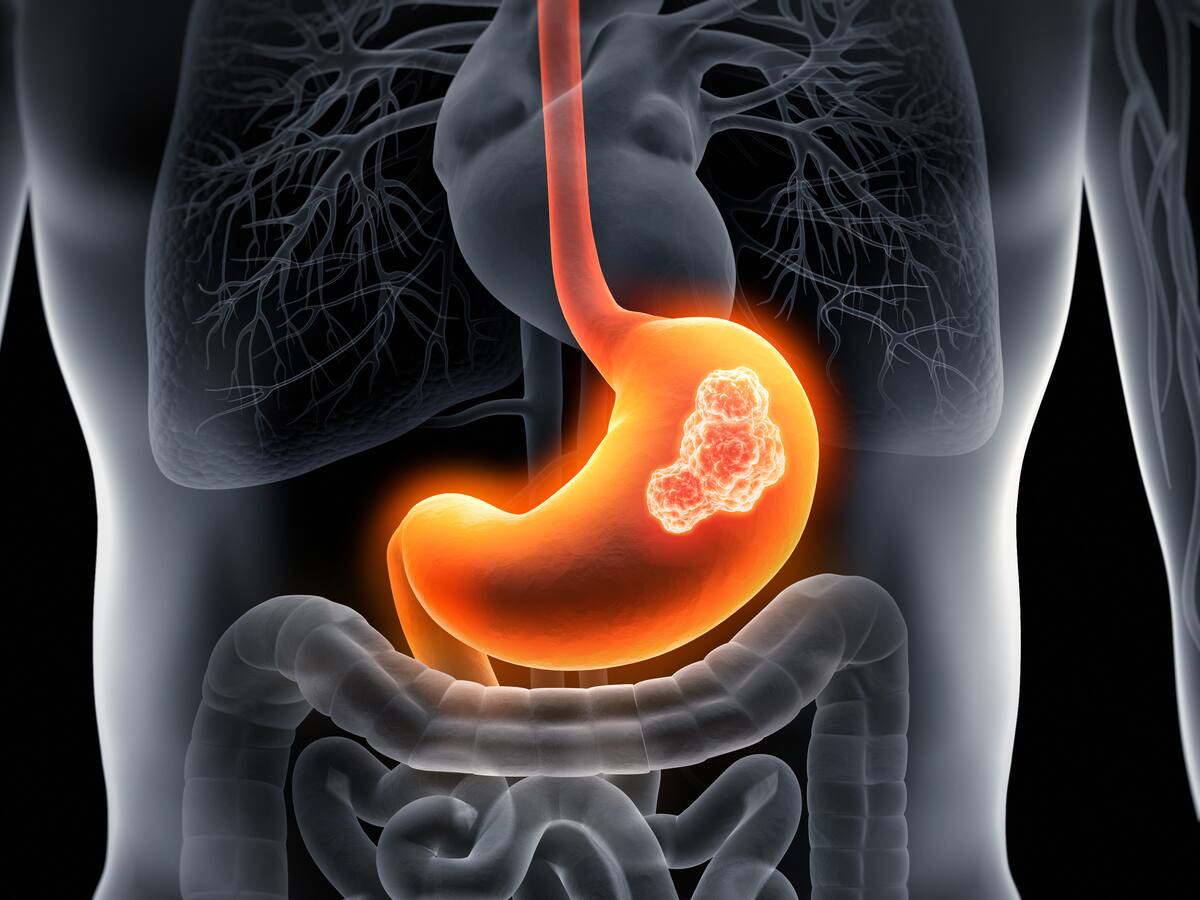 ¿Cuáles son los primeros síntomas de cáncer en el estómago? Así se manifiesta