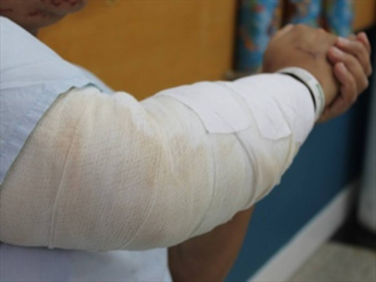 A 230 aumenta el número de quemados en Antioquia